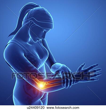 Woman with elbow pain, computer illustration. View Large Photo Image Stock Image - Woman with elbow pain, computer illustration.. Fotosearch
