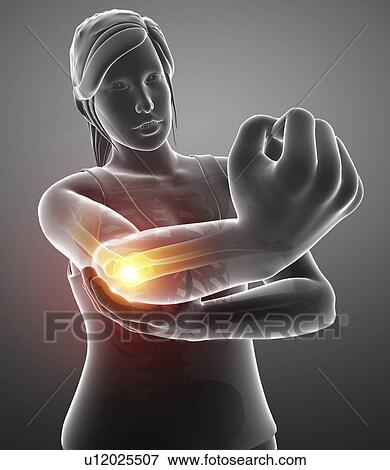 Stock Photo - Woman with elbow pain, computer illustration.. Fotosearch