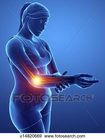 Woman with elbow pain, computer illustration. View Large Photo Image Stock Photo - Woman with elbow pain, computer illustration.. Fotosearch
