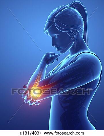 Woman with elbow pain, computer illustration. View Large Photo Image Stock Photo - Woman with elbow pain, computer illustration.. Fotosearch