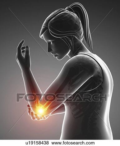 Stock Photo - Woman with elbow pain, computer illustration.. Fotosearch