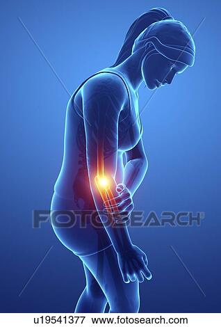 Stock Photo - Woman with elbow pain, computer illustration.. Fotosearch