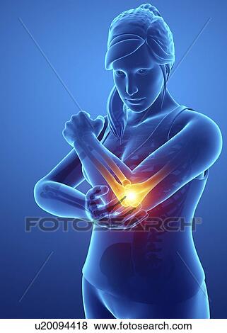 Stock Photo - Woman with elbow pain, computer illustration.. Fotosearch