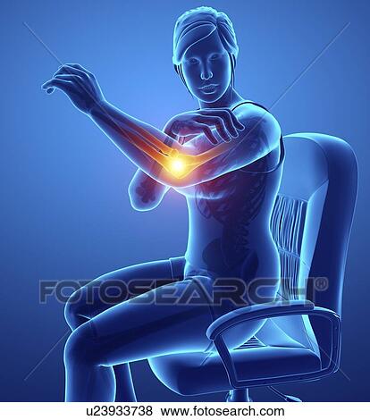 Stock Photo - Woman with elbow pain, computer illustration.. Fotosearch