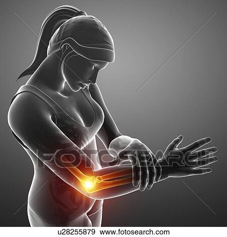 Stock Photo - Woman with elbow pain, computer illustration.. Fotosearch