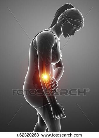 Stock Photo - Woman with elbow pain, computer illustration.. Fotosearch