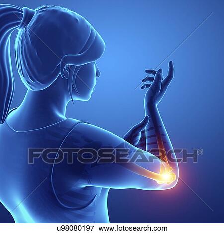 Stock Photo - Woman with elbow pain, computer illustration.. Fotosearch
