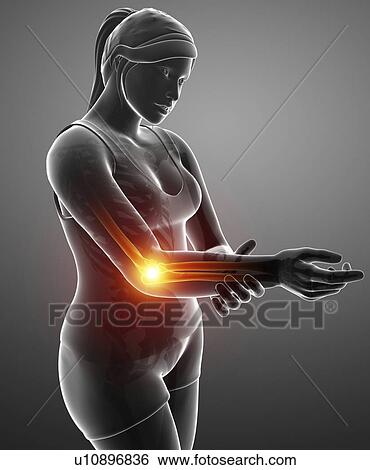 Woman with elbow pain, computer illustration. View Large Photo Image Stock Photograph - Woman with elbow pain, computer illustration.. Fotosearch