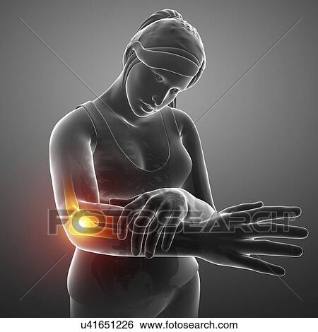 Stock Photograph - Woman with elbow pain, computer illustration.. Fotosearch