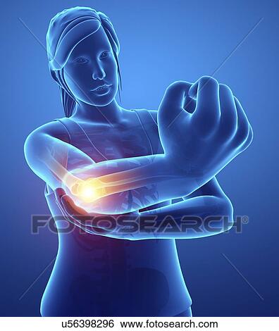 Woman with elbow pain, computer illustration. View Large Photo Image Stock Photograph - Woman with elbow pain, computer illustration.. Fotosearch