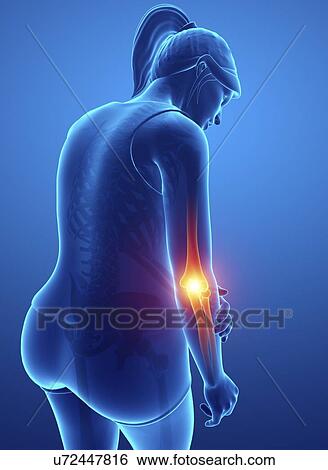 Stock Photograph - Woman with elbow pain, computer illustration.. Fotosearch
