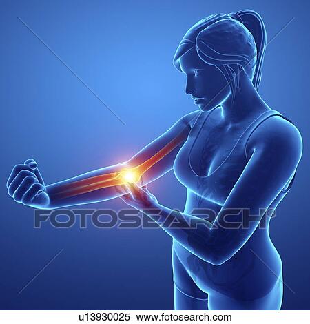 Stock Photography - Woman with elbow pain, computer illustration.. Fotosearch