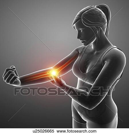 Woman with elbow pain, computer illustration. View Large Photo Image Stock Photography - Woman with elbow pain, computer illustration.. Fotosearch
