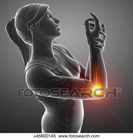 Stock Photography - Woman with elbow pain, computer illustration.. Fotosearch