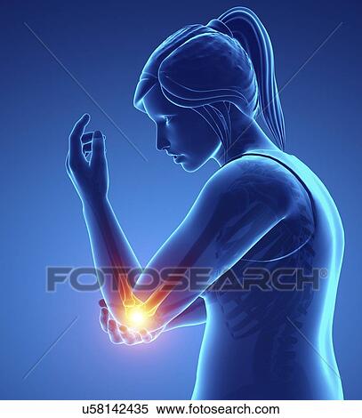 Stock Photography - Woman with elbow pain, computer illustration.. Fotosearch