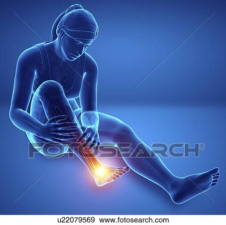 Stock Photo - Woman with foot pain, computer illustration.. Fotosearch