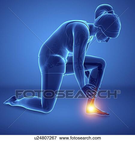 Stock Photo - Woman with foot pain, computer illustration.. Fotosearch