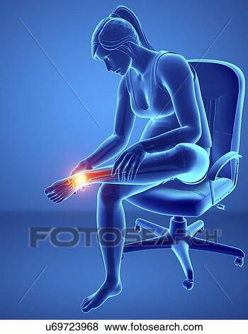 Stock Photo - Woman with foot pain, computer illustration.. Fotosearch