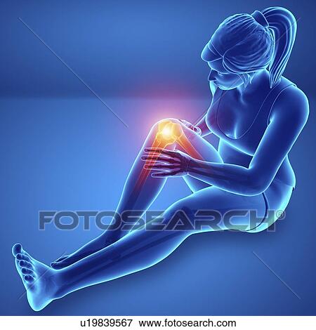 Stock Photo - Woman with knee pain, computer illustration.. Fotosearch