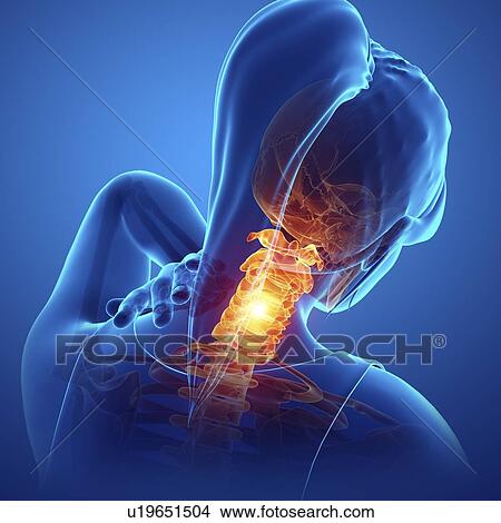 Woman with neck pain, computer illustration. View Large Photo Image Picture - Woman with neck pain, computer illustration.. Fotosearch
