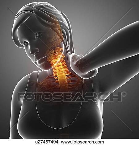 Picture - Woman with neck pain, computer illustration.. Fotosearch