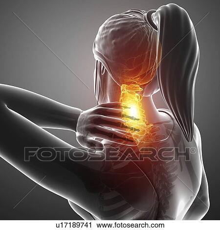 Stock Image - Woman with neck pain, computer illustration.. Fotosearch