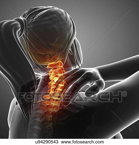 Stock Image - Woman with neck pain, computer illustration.. Fotosearch