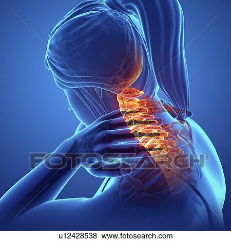 Woman with neck pain, computer illustration. View Large Photo Image Stock Photo - Woman with neck pain, computer illustration.. Fotosearch