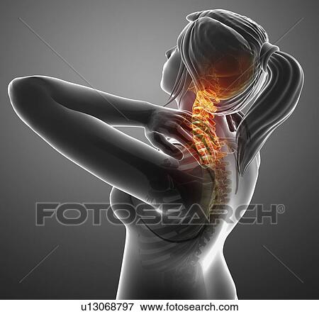 Stock Photo - Woman with neck pain, computer illustration.. Fotosearch