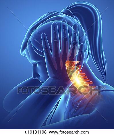 Woman with neck pain, computer illustration. View Large Photo Image Stock Photo - Woman with neck pain, computer illustration.. Fotosearch