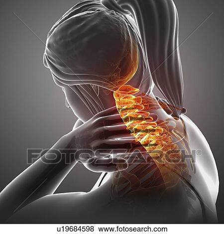 Stock Photo - Woman with neck pain, computer illustration.. Fotosearch
