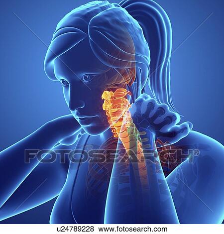 Stock Photo - Woman with neck pain, computer illustration.. Fotosearch