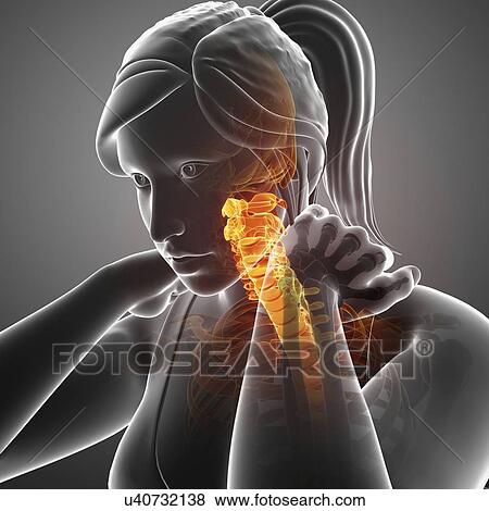Woman with neck pain, computer illustration. View Large Photo Image Stock Photo - Woman with neck pain, computer illustration.. Fotosearch