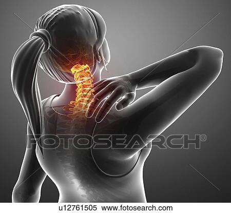 Woman with neck pain, computer illustration. View Large Photo Image Stock Photography - Woman with neck pain, computer illustration.. Fotosearch