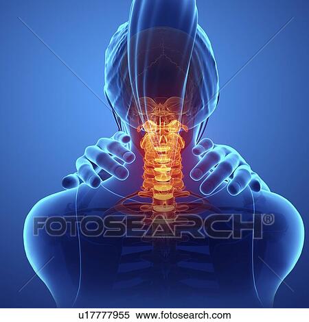 Stock Photography - Woman with neck pain, computer illustration.. Fotosearch