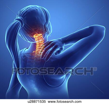 Stock Photography - Woman with neck pain, computer illustration.. Fotosearch