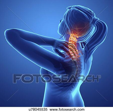Stock Photography - Woman with neck pain, computer illustration.. Fotosearch