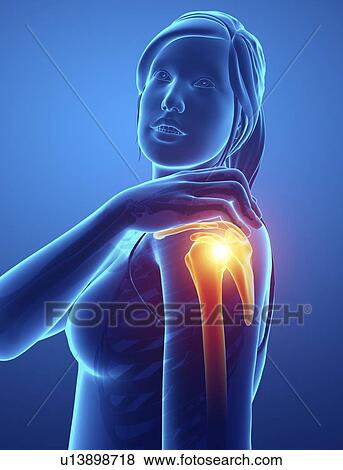 Stock Photo - Woman with shoulder pain, computer illustration.. Fotosearch