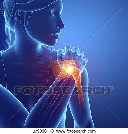 Stock Photo - Woman with shoulder pain, computer illustration.. Fotosearch