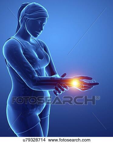 Picture - Woman with wrist pain, computer illustration.. Fotosearch