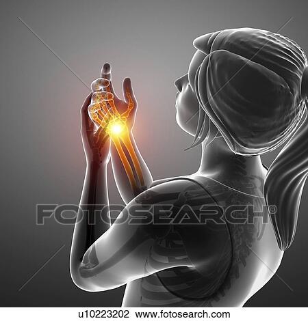 Stock Image - Woman with wrist pain, computer illustration.. Fotosearch