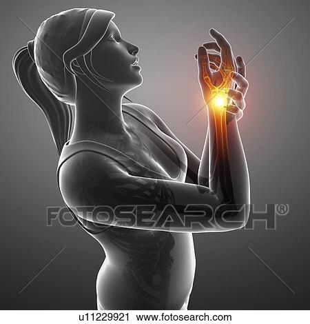 Stock Image - Woman with wrist pain, computer illustration.. Fotosearch