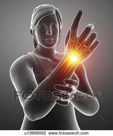 Stock Image - Woman with wrist pain, computer illustration.. Fotosearch