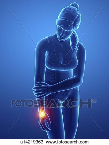 Stock Image - Woman with wrist pain, computer illustration.. Fotosearch