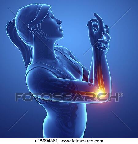 Stock Image - Woman with wrist pain, computer illustration.. Fotosearch