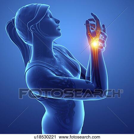 Stock Image - Woman with wrist pain, computer illustration.. Fotosearch