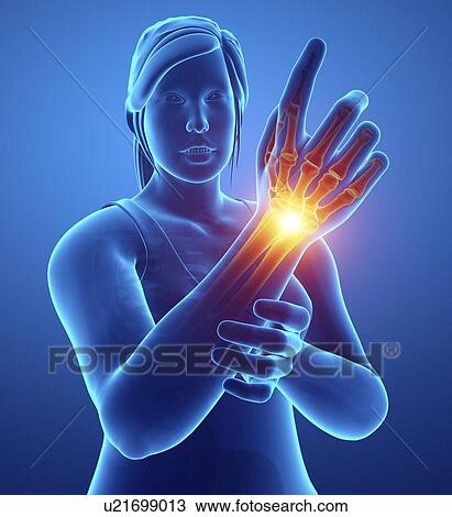 Woman with wrist pain, computer illustration. View Large Photo Image Stock Image - Woman with wrist pain, computer illustration.. Fotosearch