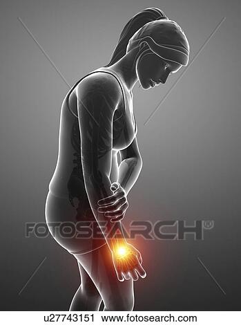 Stock Image - Woman with wrist pain, computer illustration.. Fotosearch
