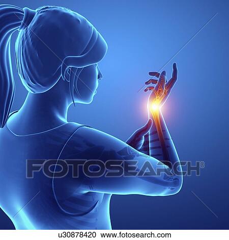 Stock Image - Woman with wrist pain, computer illustration.. Fotosearch