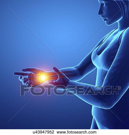 Stock Image - Woman with wrist pain, computer illustration.. Fotosearch